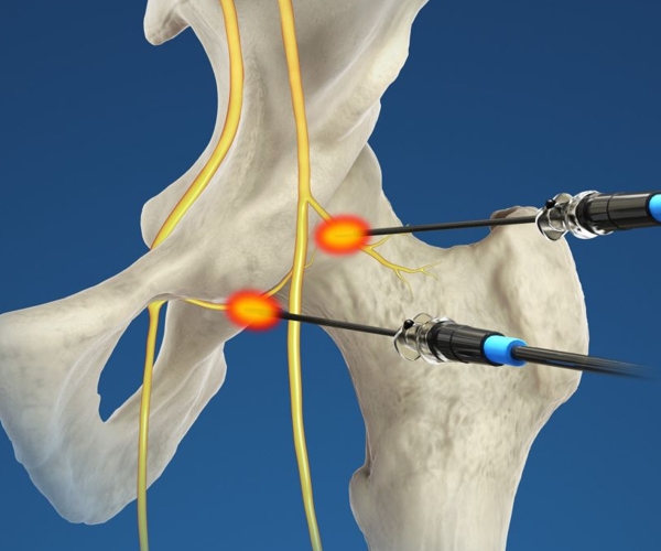 Radiologia Interventistica Muscolo-Scheletrica